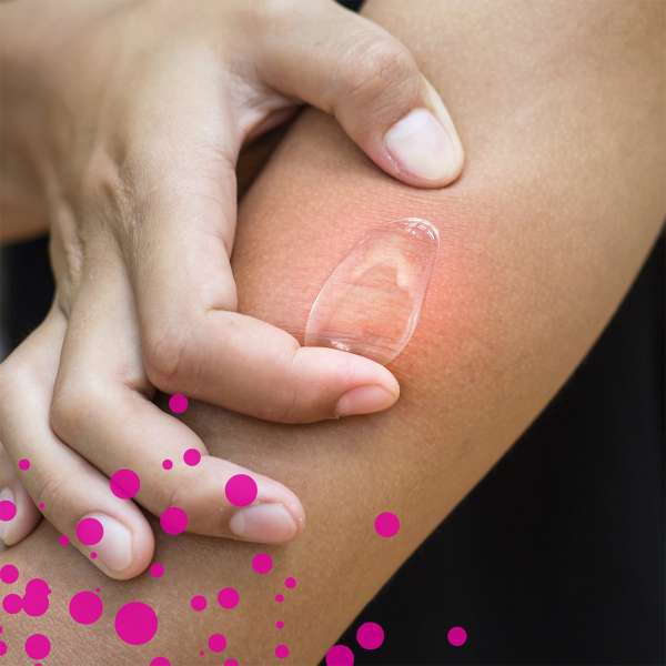 Emcur Insektenstich-Gel kaufen